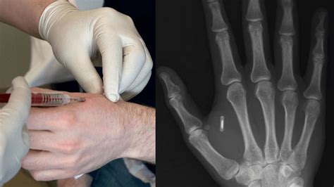 are rfid chip embeded in us dollars|These Workers Have Got a Microchip Implanted in Their Hand .